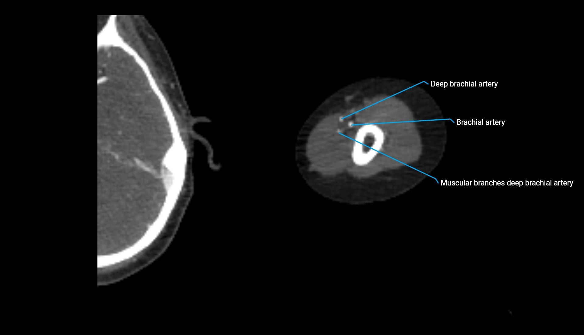 CTA upper limb axial cross sectional anatomy labelled image 255 (2).webp
